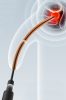 Lexia vibráló húgycső stimulátor - 15 cm, 2,5 mm átmérő